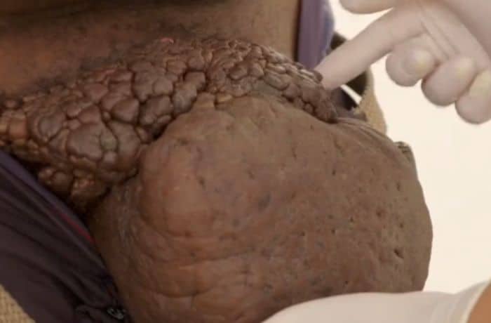 Pimple Popper - Twitter/TLC