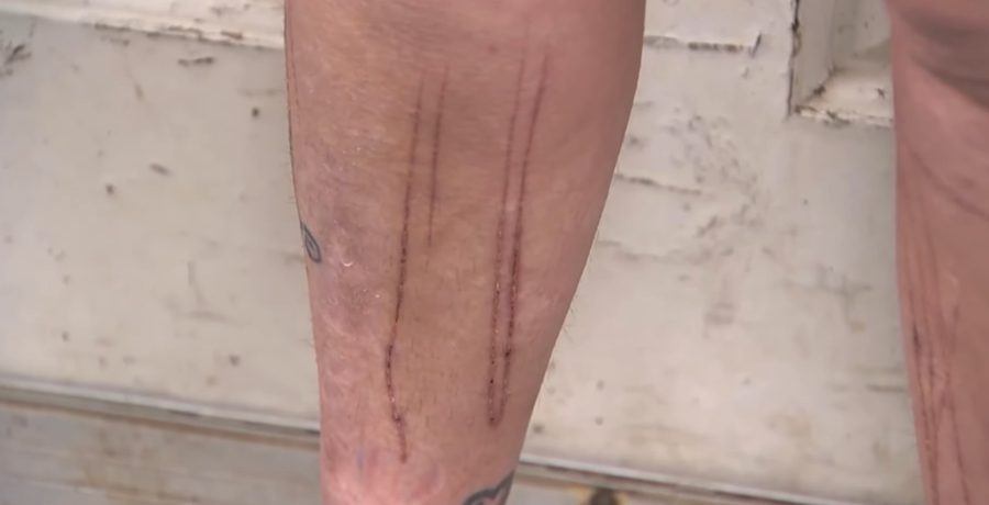 Brandy Williard's scars - YouTube