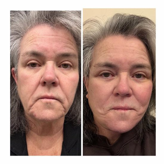 Rosie O'Donnell before and after facelift/Credit: Instagram
