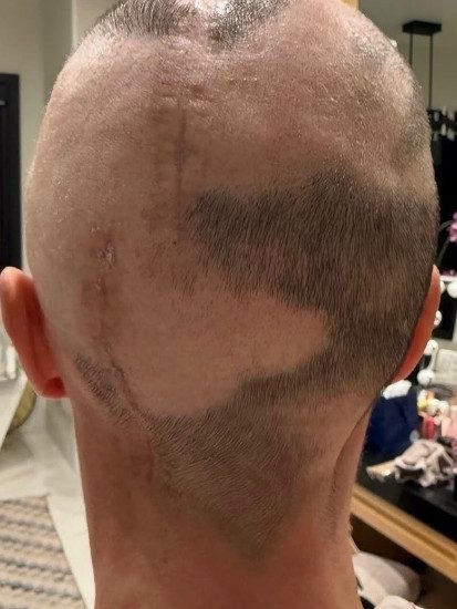Teddi Mellencamp shows her brain surgery scars/Credit: Instagram